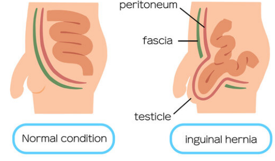 ما هو الفتق الإربي عند الرضع؟